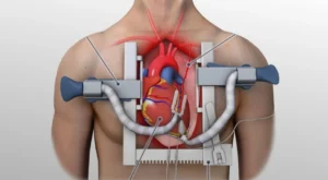 Bypass Ameliyatı Nasıl Yapılır?