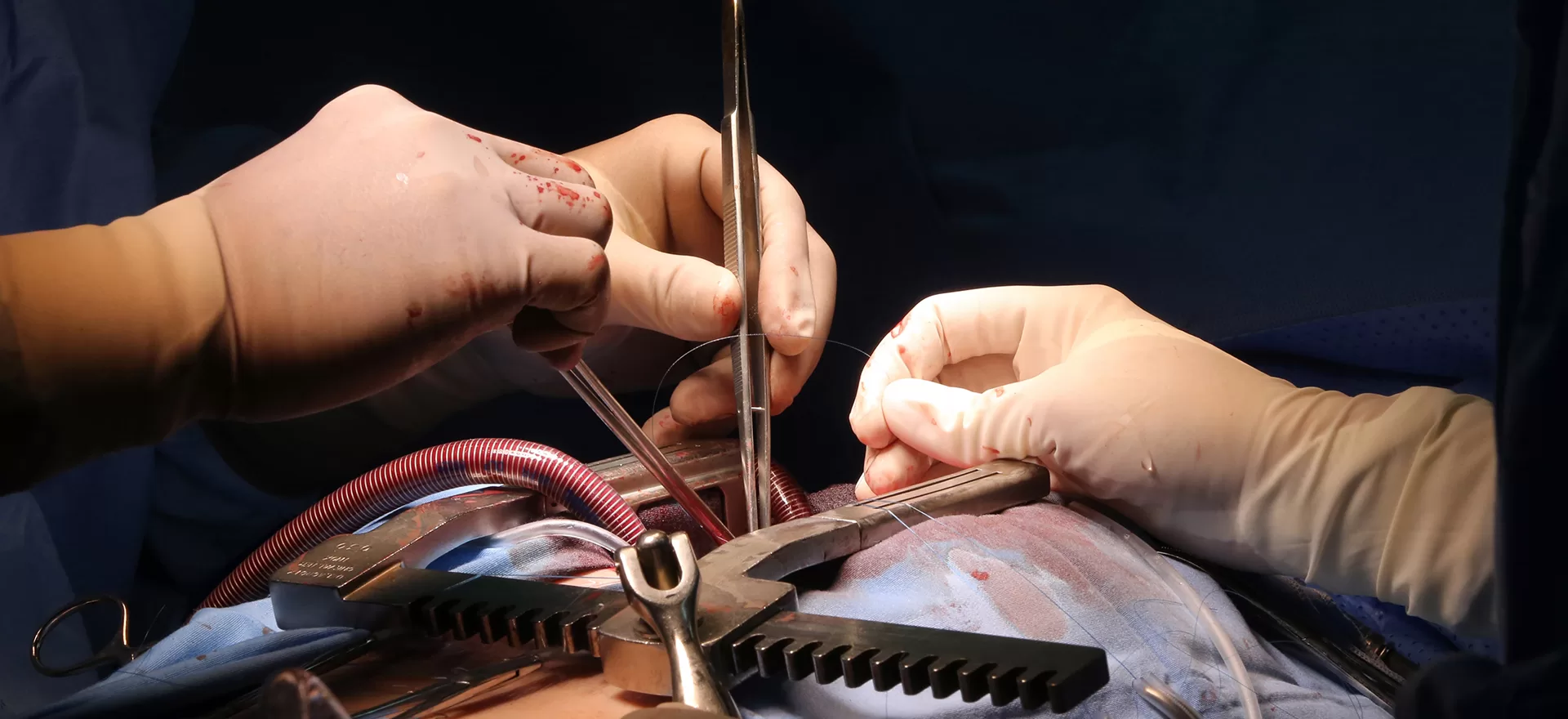 Baypas Ameliyati Riskleri