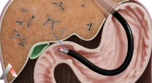 Akciğer Biyopsi Nasıl Yapılır?